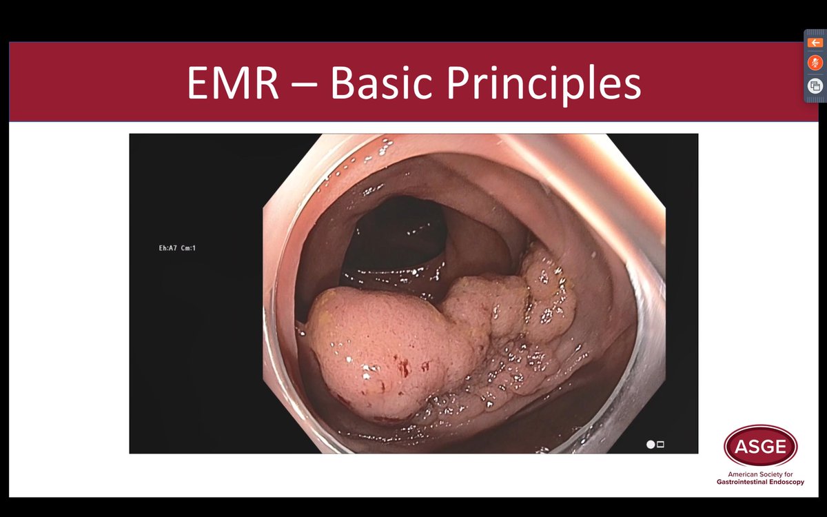 carlosfrncscomd's tweet photo. Great course by @ASGEendoscopy ! There is so much to learn. 
Endo Hangouts for GI Fellows, Polypectomy Techniques II
#GIFellows #GITwitter #GIEndoscopy #gastroenterology #endoscopy https://t.co/tjR8qr5cpg