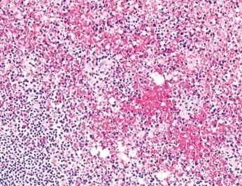 AJCPjournal's tweet photo. Read the first autopsy study specifically looking at the reticuloendothelial organs in fatal #COVID19. @april_path @Jmarksloan  https://t.co/o4ZAPwcqQQ https://t.co/EliGqSC6Mc