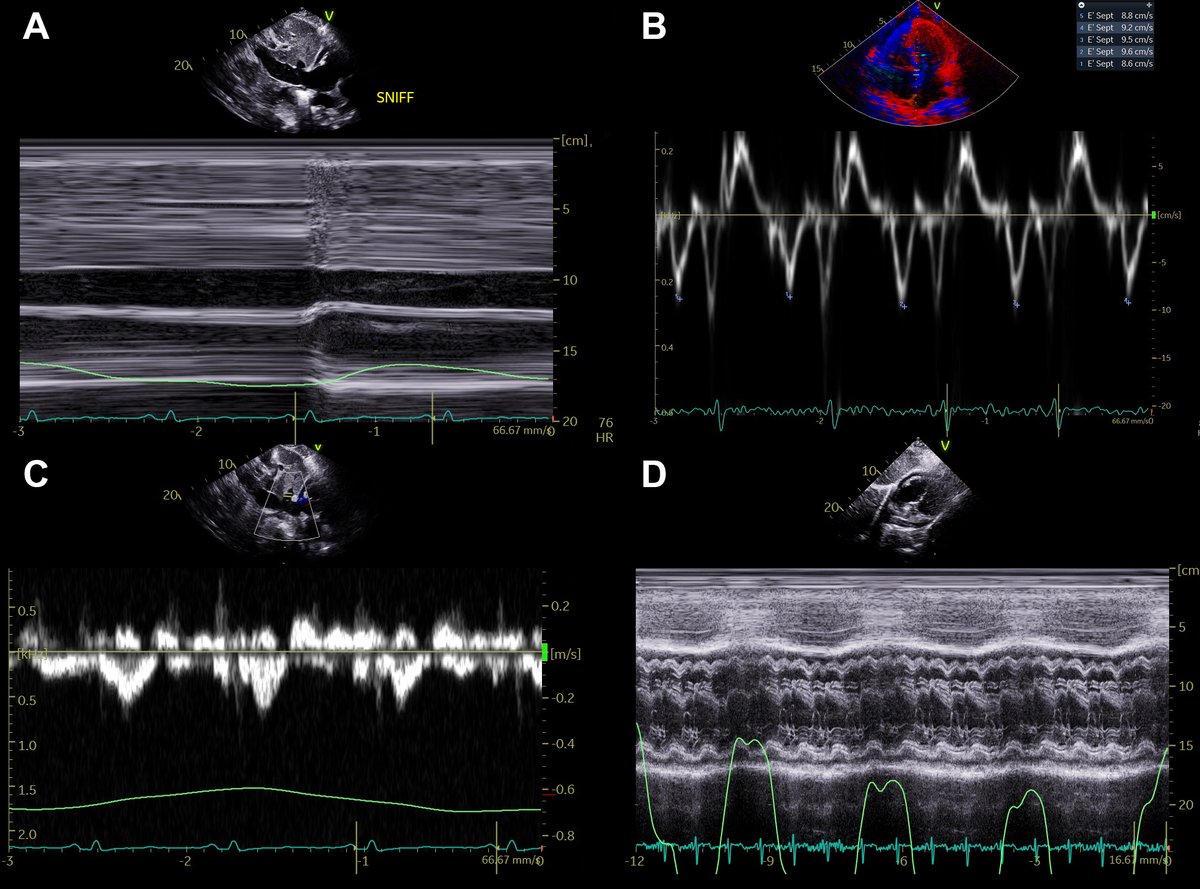 (A) a dilated inferior vena cava with <50% respiratory variation, (B) a septal mitral annular e’ velocity of 9.5 cm/sec, (C) mild diastolic reversal of the hepatic vein with expiration not meeting diagnostic criteria ...