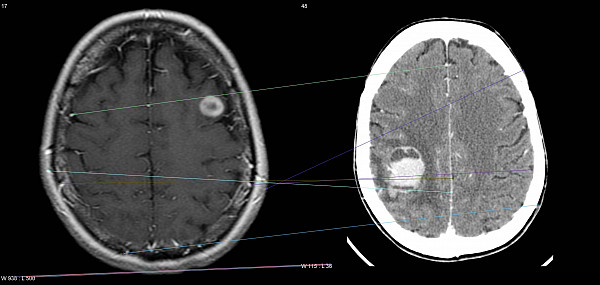 Websystemer's tweet image. RoboDoc , using Machine Learning to detect brain tumors - websystemer.no/robodoc-using-…
 #knnalgorithm #machinelearning #python #sift #tkinter