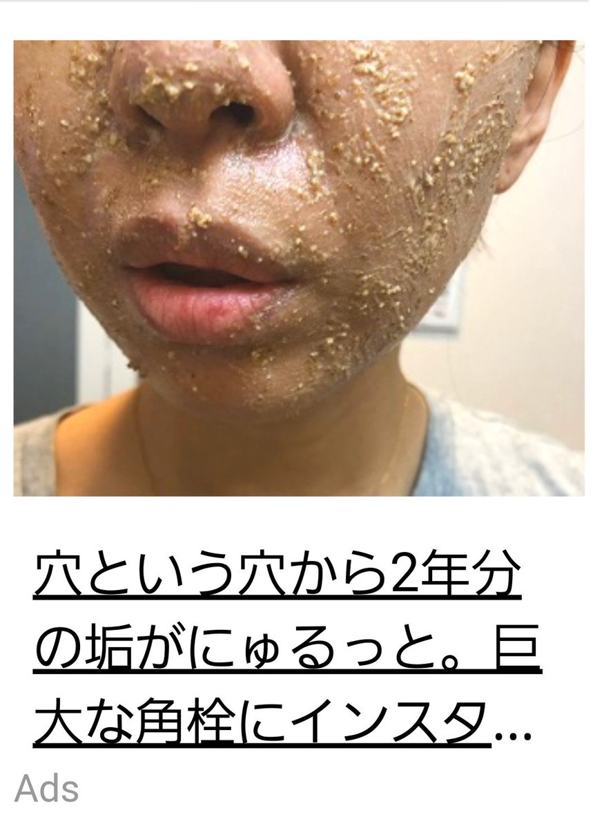 ﾓﾆｮﾓﾆｮのウツボ 画像閲覧注意 穴という穴から2年分の垢がにゅるっと 巨大な角栓にインスタ炎上 とかいう広告があったんだけど 顔に胡麻ドレッシング塗っとるやろwww T Co 6rjx2ottab Twitter