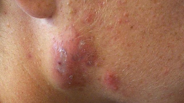 5. Bengkak, benjolan yang penuh dengan nanah di bawah permukaan kulit (jerawat cyst) – Cysts adalah besar, luka yang penuh nanah yang kelihatan sama dengan bisul. Seperti nodul, cyst boleh menyakitkan dan harus dirawat oleh pakar dermatologi.