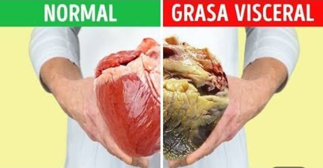 nutrimundo's tweet image. La grasa visceral (grasa distribuida entre los órganos internos del cuerpo) predispone a padecer enfermedades crónicas como diabetes, problemas cardíacos, hipertensión, hiperlipidemias e incluso cáncer.