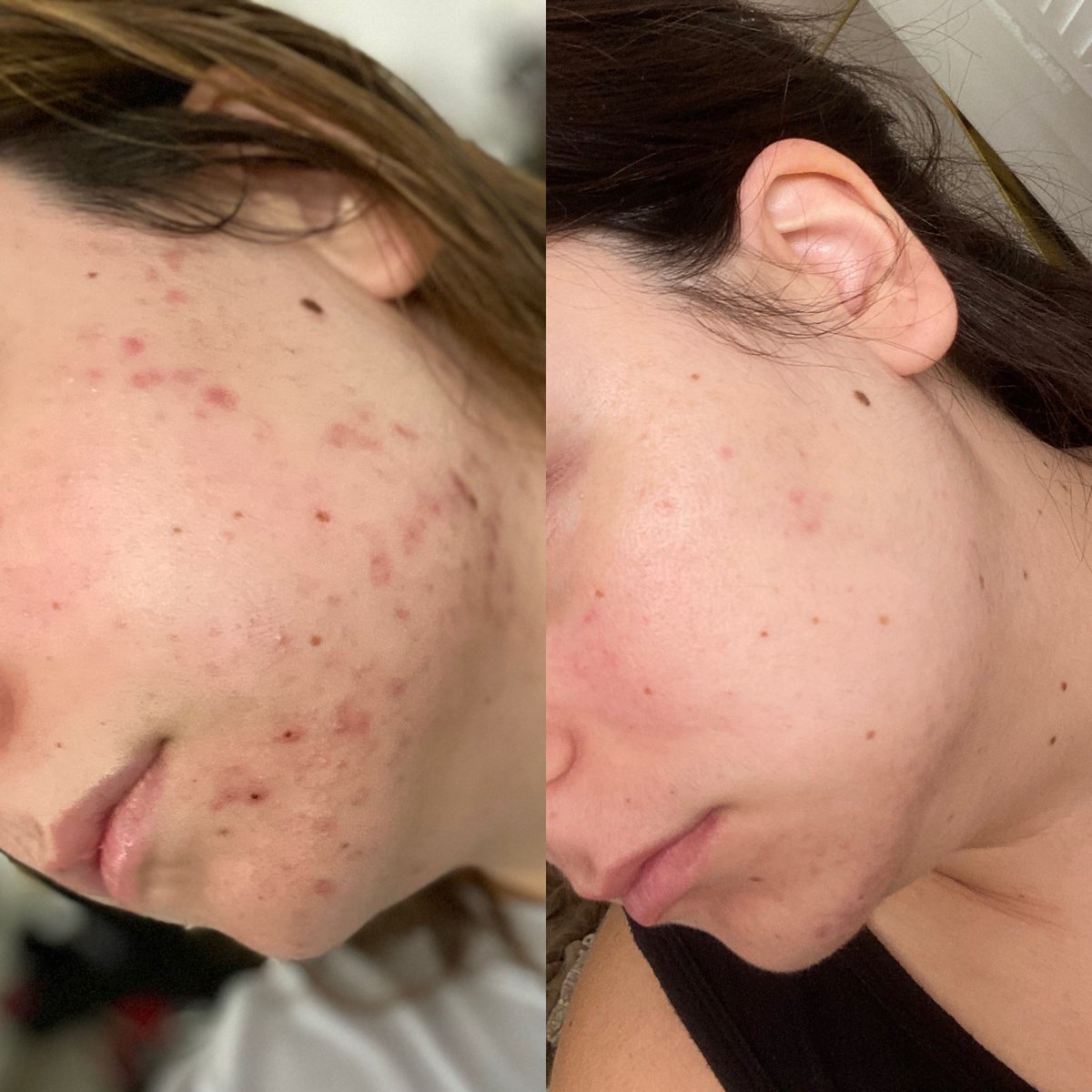 skincarebyhyram acne scars