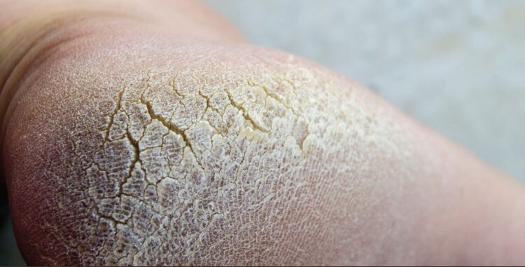 tariqtramboo's tweet photo. If your feet skin looks cracked, get blood sugar done. When your blood sugar is too high, your body takes water from all over your body to compensate including your skin. https://t.co/WXdNYRu7po