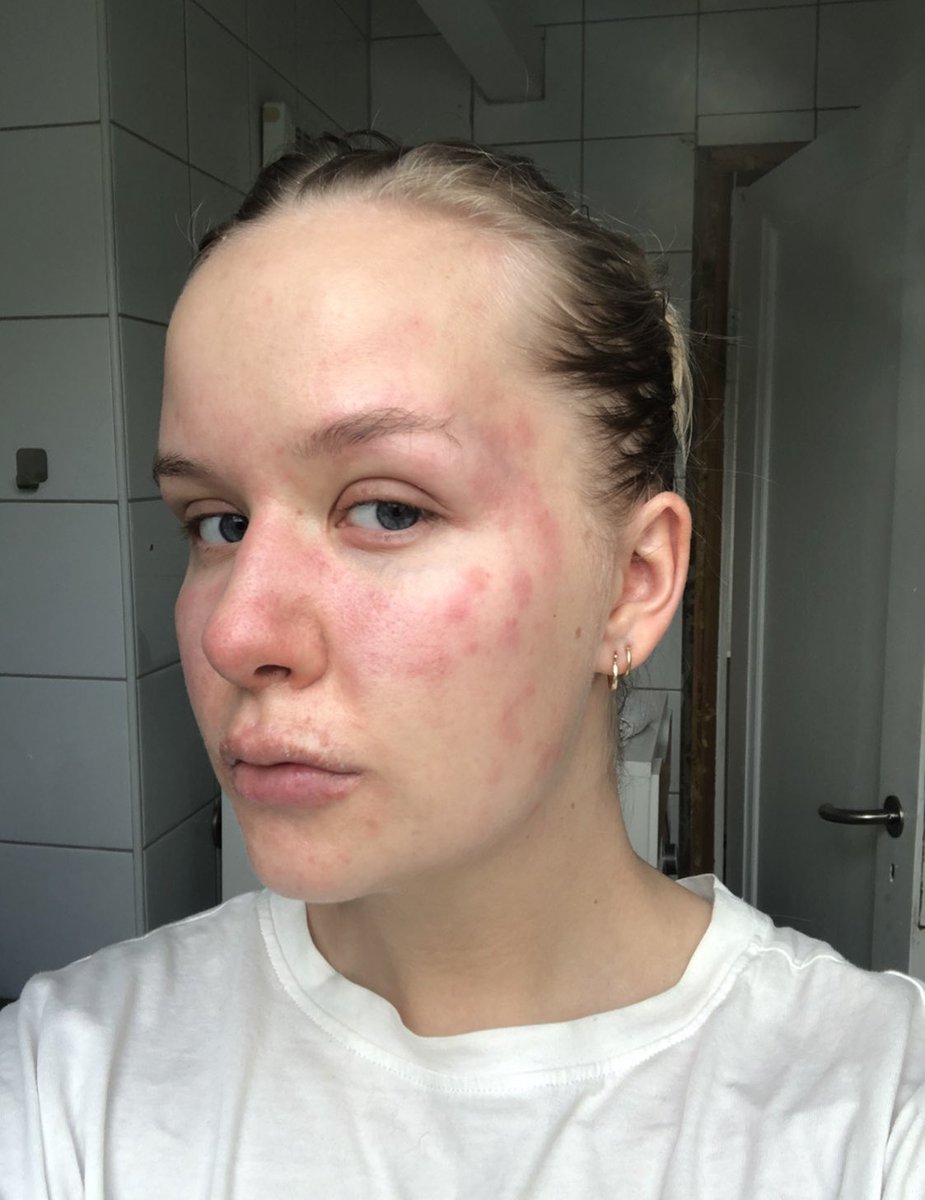 makeuphenri_'s tweet photo. My skincondition has not let me do makeup for a few months now, which was especially hard during the pandemic.. but treatment is working, I’m getting better and I will be back soon! @keilidhmua ‘s #KASHbeauty will definetly be one of the first things I’ll put on my face!! https://t.co/U52hrfCZ0a