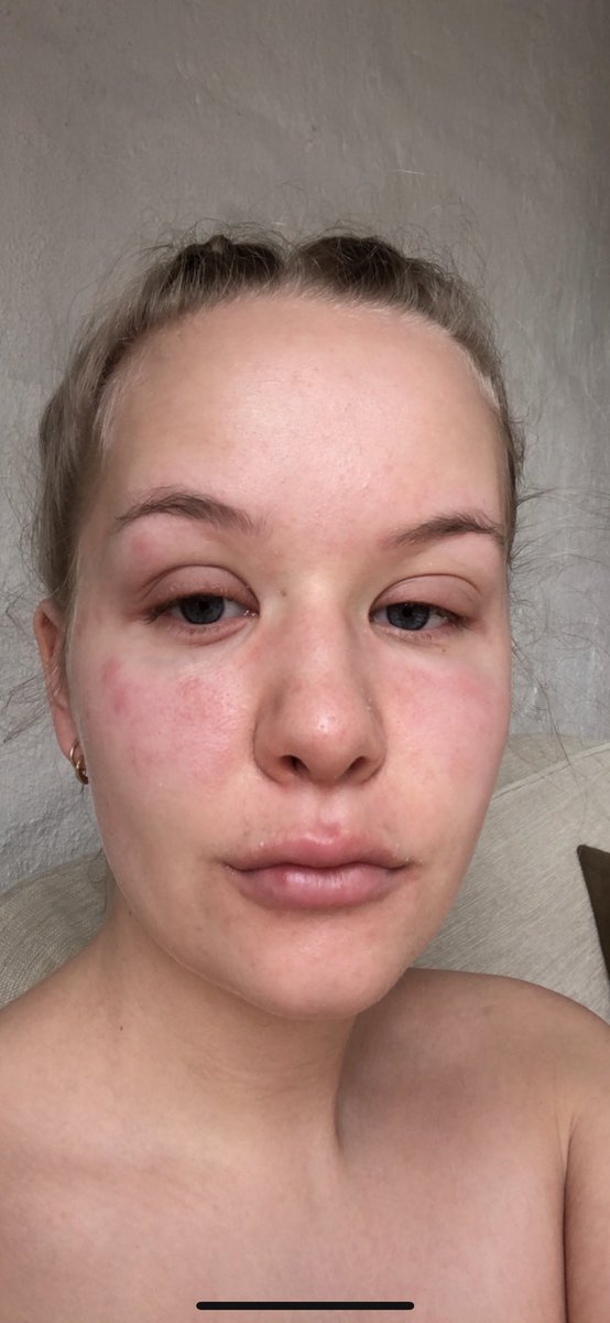 makeuphenri_'s tweet photo. My skincondition has not let me do makeup for a few months now, which was especially hard during the pandemic.. but treatment is working, I’m getting better and I will be back soon! @keilidhmua ‘s #KASHbeauty will definetly be one of the first things I’ll put on my face!! https://t.co/U52hrfCZ0a