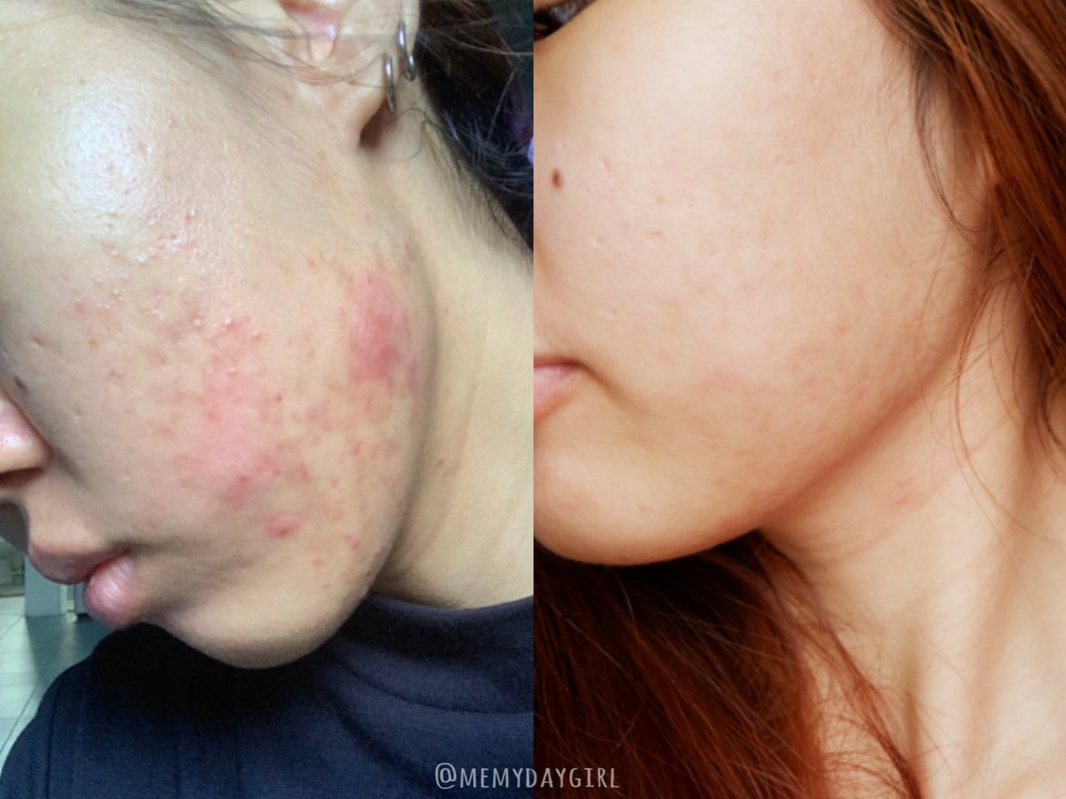 aoomsinptd's tweet image. Skincare ช่วงเป็นสิวของเราเองอันนี้ ใช้เวลารักษามาตลอด2เดือน ไม่ได้ใช้หมดนี่ต่อ 1 วันนะ แต่จะสลับกันใช้ไปแล้วแต่สภาพผิว ณ ตอนนั้นที่อยากรักษาจริงๆ 

—แต่อันดับแรกก็ต้องรักษาสิวก่อนอะ ทีละสเต็ป อาจจะดูเยอะมากแต่นี่คือ 2 เดือนกว่าๆนะทุกคนที่เราใช้ 🤍 #ไว้รีวิวห้ามขายของโว้ยย