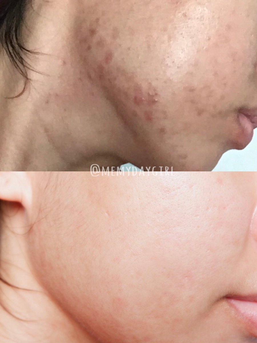 aoomsinptd's tweet image. Skincare ช่วงเป็นสิวของเราเองอันนี้ ใช้เวลารักษามาตลอด2เดือน ไม่ได้ใช้หมดนี่ต่อ 1 วันนะ แต่จะสลับกันใช้ไปแล้วแต่สภาพผิว ณ ตอนนั้นที่อยากรักษาจริงๆ 

—แต่อันดับแรกก็ต้องรักษาสิวก่อนอะ ทีละสเต็ป อาจจะดูเยอะมากแต่นี่คือ 2 เดือนกว่าๆนะทุกคนที่เราใช้ 🤍 #ไว้รีวิวห้ามขายของโว้ยย