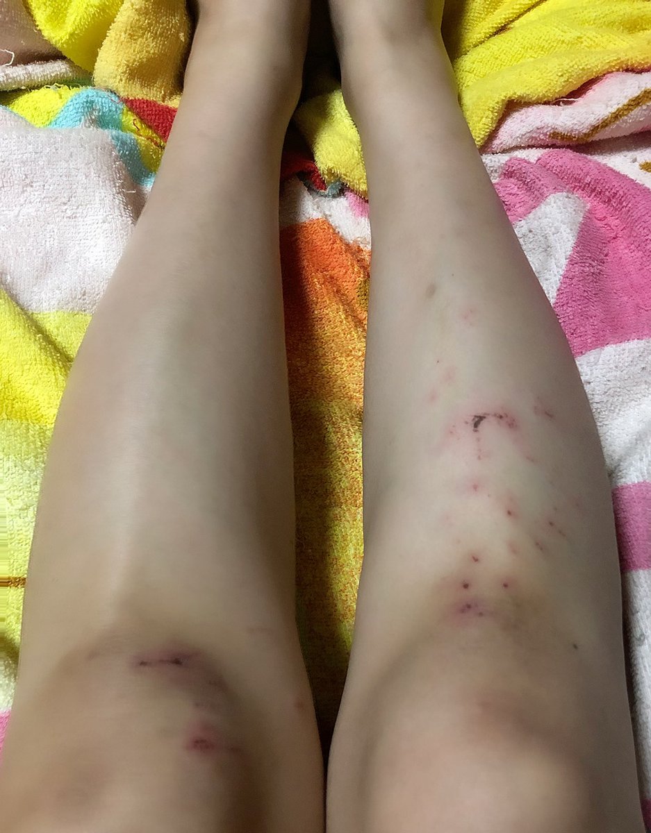 vivi_singing's tweet photo. 台風で被害が少なくなるように家周りの物片付けてたら、塀から落ちて汚めな怪我した😂

私一生足に怪我をつくる人生なのかもしれん笑 https://t.co/7vsd7fBkk9
