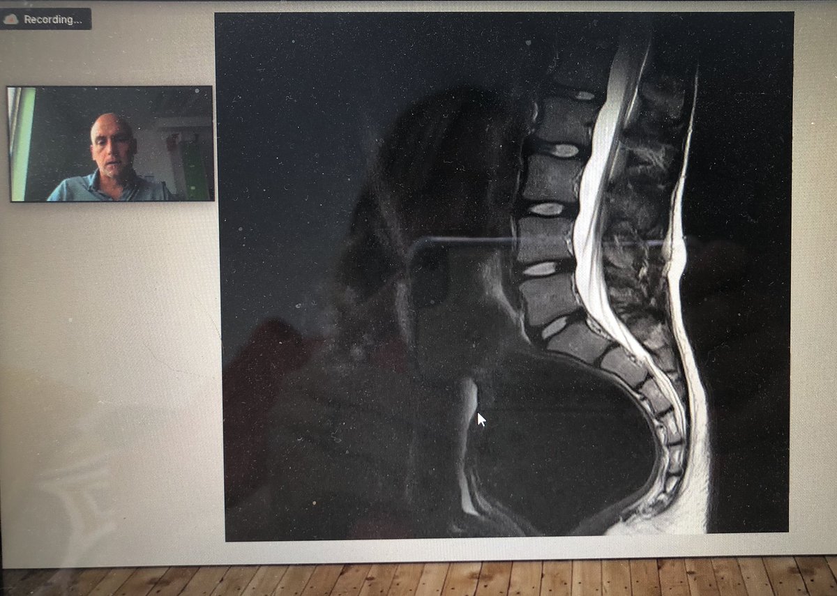 Spinal masquerades expanded running virtually right now! <a href="/mercephysio1/">@mercephysio</a> discussing if this megarectum could be the cause of pts back pain... thinking outside the box <a href="/LaurafinucaneB/">Laura Finucane</a> #macpcourses
