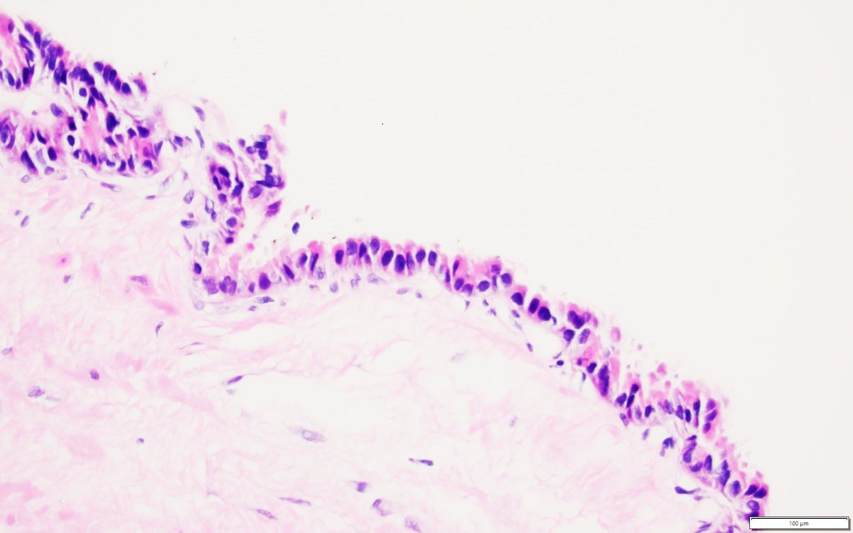 pbpath's tweet photo. Check out the latest #CaseoftheQuarter.
Please review the case and check your #PBPath knowledge!
https://t.co/AiNZuFkkrh
Case contributed by
Dr.Yue Xue and Dr.Rebecca Obeng @NU_Pathology
#pancpath #SurgPath https://t.co/3bm7k1ZJJ0