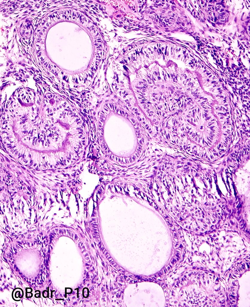 My first case in @pathologyTweet .17 yrs old Female with anterior maxillary lesion. Diagnosis? @ENTpath @DrGeeONE @SumantaDas_7 @jyeolipark @AnnieMcLeanDMD @seyma_buyucek @Divya_Madhala