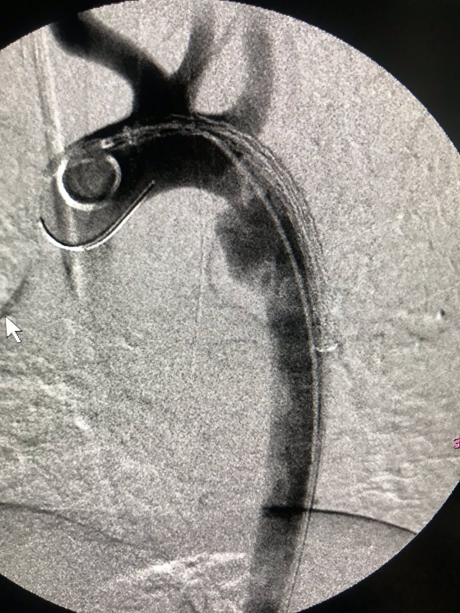 grounds4riots's tweet photo. Don’t forget to optimize MPR use in trauma imaging. #aortictransection are best seen in saggital plane.
EmergencyTEVAR✅
Notice the challenges of a smaller aorta in type 1 arch.
For more tips and tricks in TEVAR / Join me&Prof Brennan Mon14/09 at 1730-1830 ECT #CIRSE2020 #Irad https://t.co/QJwRqGHVXv