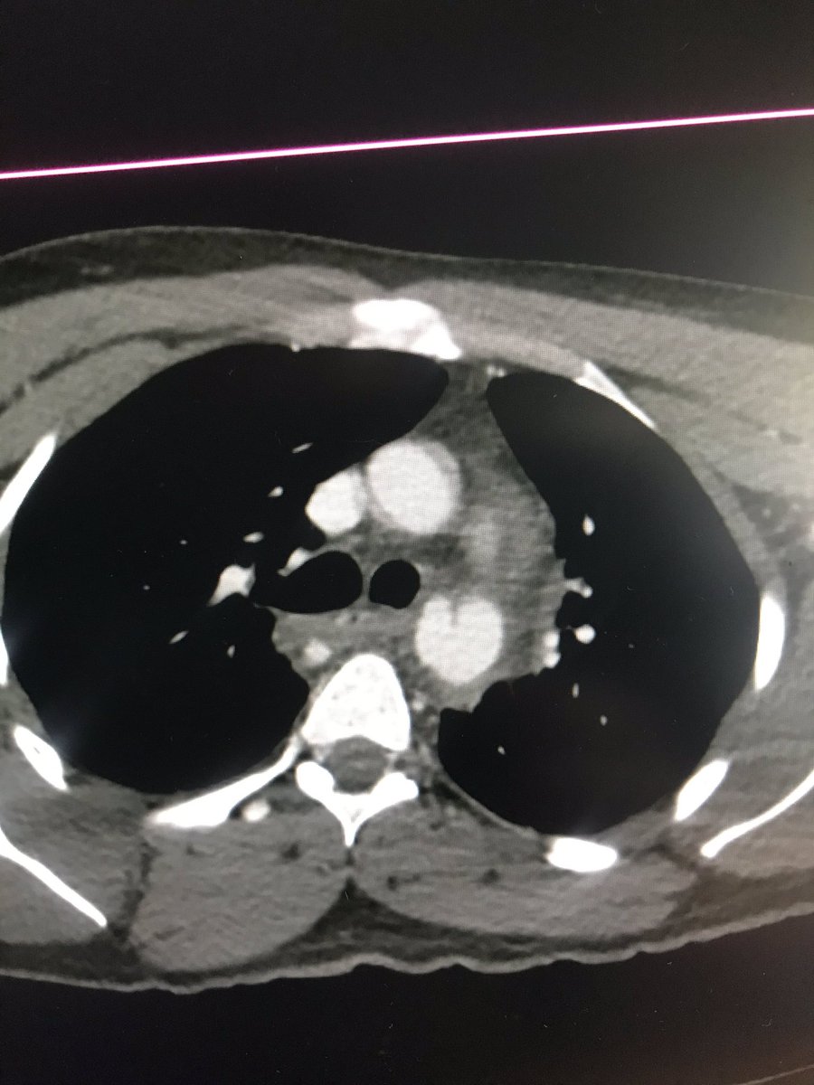 grounds4riots's tweet photo. Don’t forget to optimize MPR use in trauma imaging. #aortictransection are best seen in saggital plane.
EmergencyTEVAR✅
Notice the challenges of a smaller aorta in type 1 arch.
For more tips and tricks in TEVAR / Join me&Prof Brennan Mon14/09 at 1730-1830 ECT #CIRSE2020 #Irad https://t.co/QJwRqGHVXv