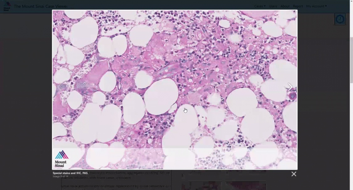 feldstej's tweet photo. #weekview #weekvibes #weekthoughts #weekmotivation #weekwisdom #weekmorphology #weekcase #courtesy #matthewshapiro #resident #cp #bonemarrow #mssm #pathology #bloodcancerawarenessmonth #bcam #mmsm #pathtwitter #medtwitter #icahnmssm https://t.co/2Hm5CqiPt1