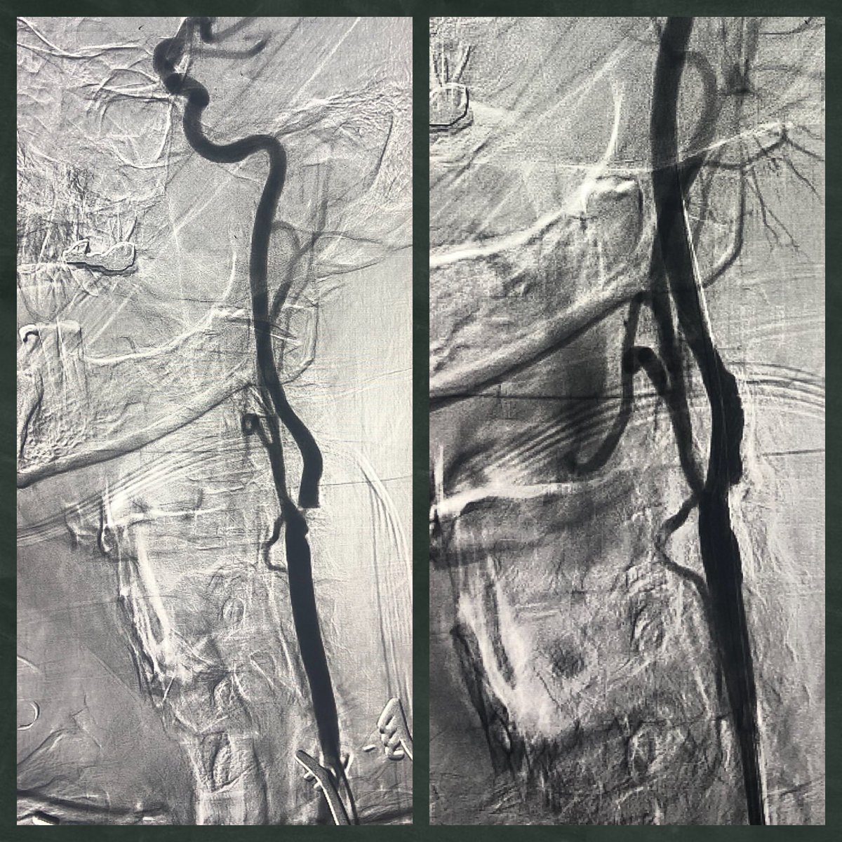 NaveedSaqibMD's tweet photo. High risk, High grade Left carotid stenosis treated with #awake #TCAR under local anesthesia and #flowreversal protection using @SilkRoadMed @memorialhermann @UTH_CVSurgery @UTPhysicians https://t.co/GBT7MA5Q2a