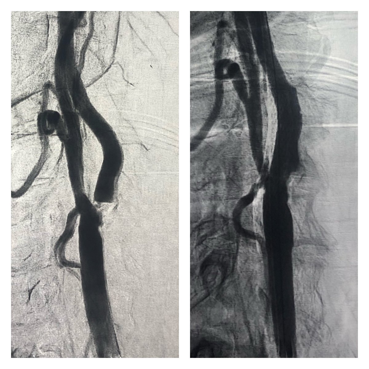 NaveedSaqibMD's tweet photo. High risk, High grade Left carotid stenosis treated with #awake #TCAR under local anesthesia and #flowreversal protection using @SilkRoadMed @memorialhermann @UTH_CVSurgery @UTPhysicians https://t.co/GBT7MA5Q2a