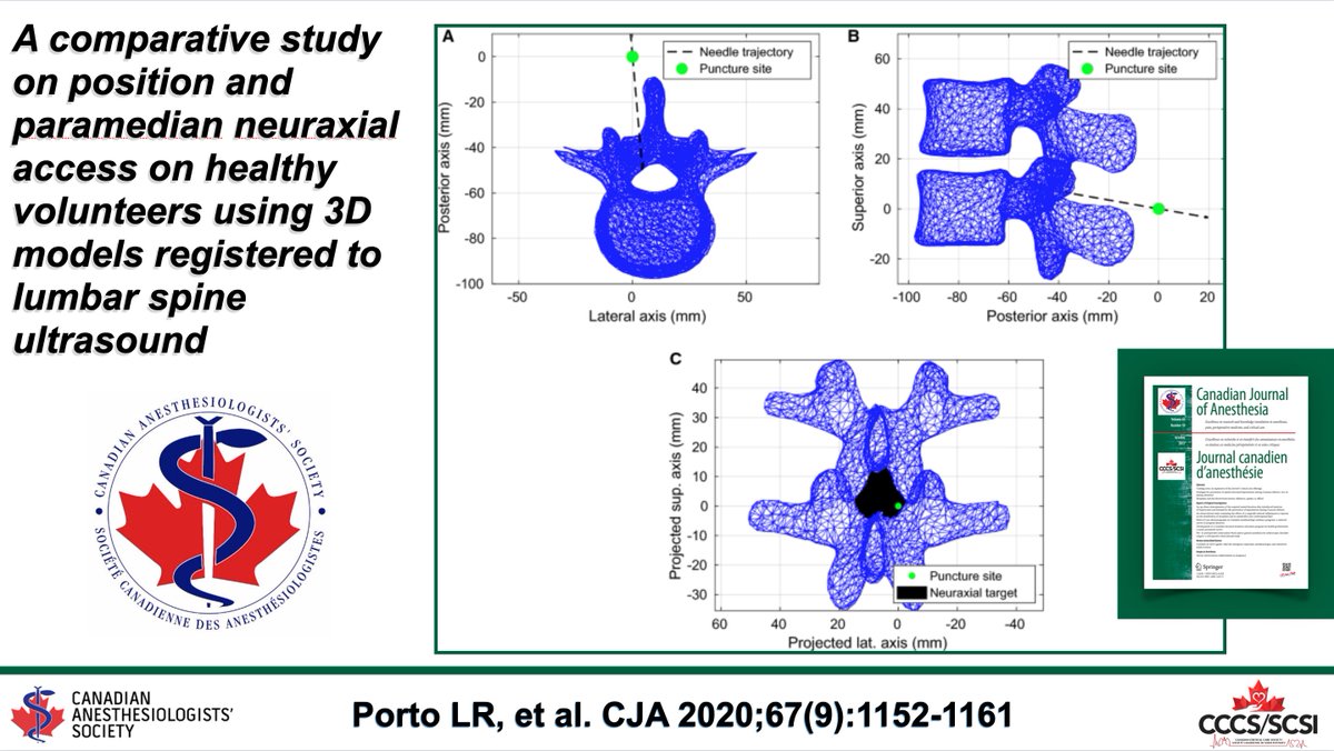 CJA_Journal's tweet photo. A comparative study on position and paramedian neuraxial access on healthy volunteers using three-dimensional models registered to lumbar spine ultrasound https://t.co/dUPlPEYBV6 #CJA #Anesthesia #Anesthesiology https://t.co/M4vVhQZyIQ