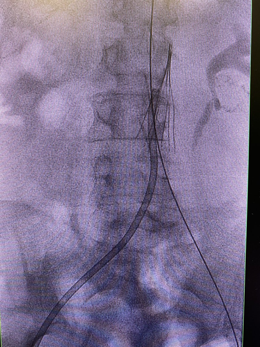 John Moriarty (@jonnymoriarty) on Twitter photo Acute on chronic iliocaval thrombectomy w CAT12 Lightening ⚡️...super fast restoration of flow and 😄patient Acute on chronic iliocaval thrombectomy w CAT12 Lightening ⚡️...super fast restoration of flow and 😄patient