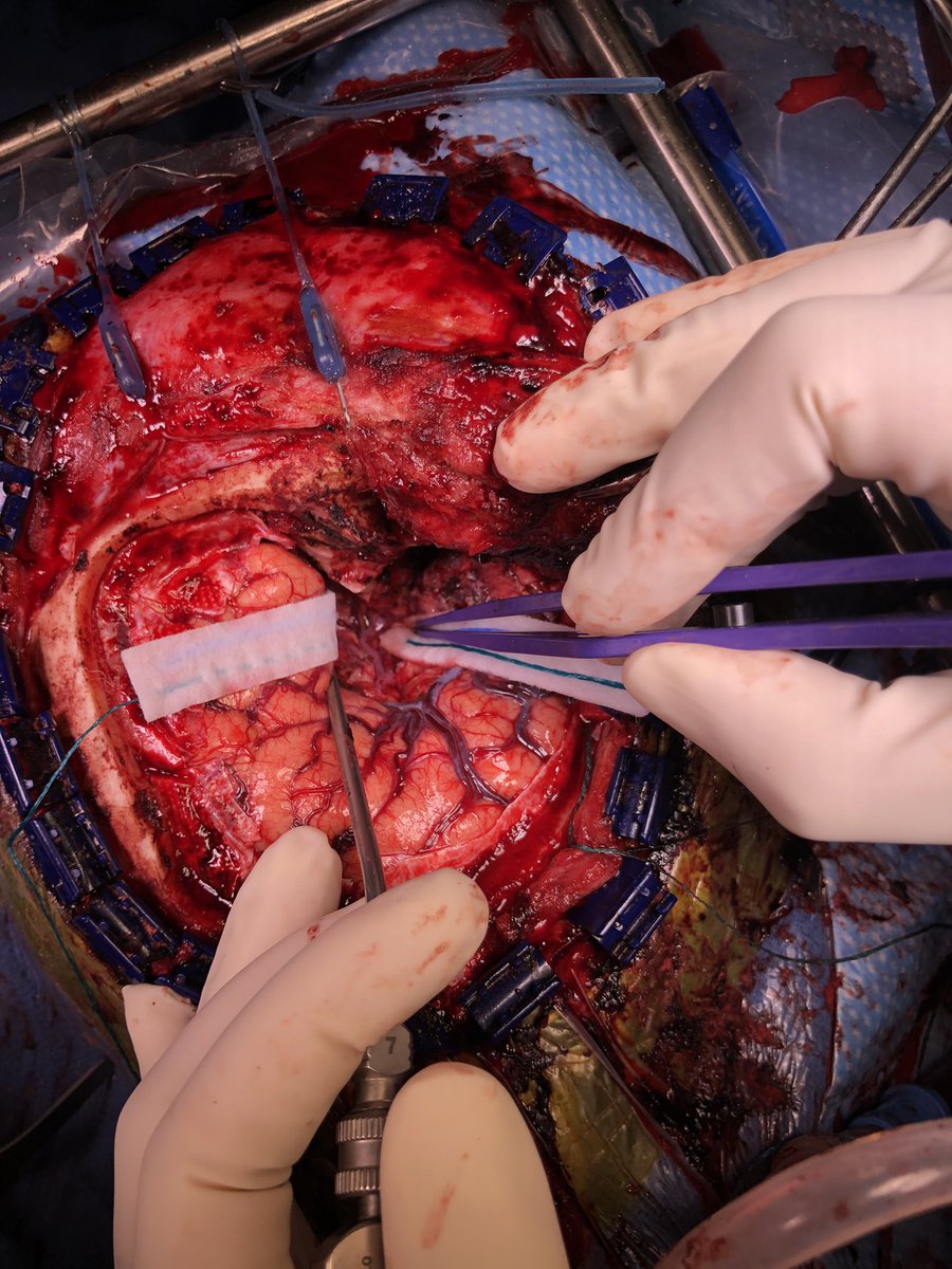 Shamik Chakraborty, M.D. (@drshamikc) on Twitter photo Removing this patientās sphenoid wing meningioma was a bear of a case! Lots of vessels adherent to this very fibrotic tumor. With the help of <a href="/MohsenNouriMD/">Mohsen Nouri</a>, <a href="/AmritChiluwalMD/">Dr Amrit K. Chiluwal</a> and OR staff at <a href="/JamaicaHospital/">Jamaica Hospital</a>, this woman is completely intact with gross total removal of her tumor! Removing this patientās sphenoid wing meningioma was a bear of a case! Lots of vessels adherent to this very fibrotic tumor. With the help of <a href="/MohsenNouriMD/">Mohsen Nouri</a>, <a href="/AmritChiluwalMD/">Dr Amrit K. Chiluwal</a> and OR staff at <a href="/JamaicaHospital/">Jamaica Hospital</a>, this woman is completely intact with gross total removal of her tumor!