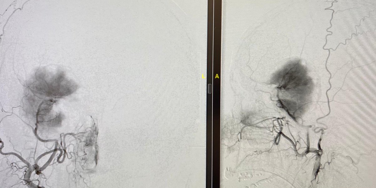 drshamikc's tweet photo. Removing this patient’s sphenoid wing meningioma was a bear of a case! Lots of vessels adherent to this very fibrotic tumor. With the help of @MohsenNouriMD, @AmritChiluwalMD and OR staff at @JamaicaHospital, this woman is completely intact with gross total removal of her tumor! https://t.co/GtdsBuAXJu