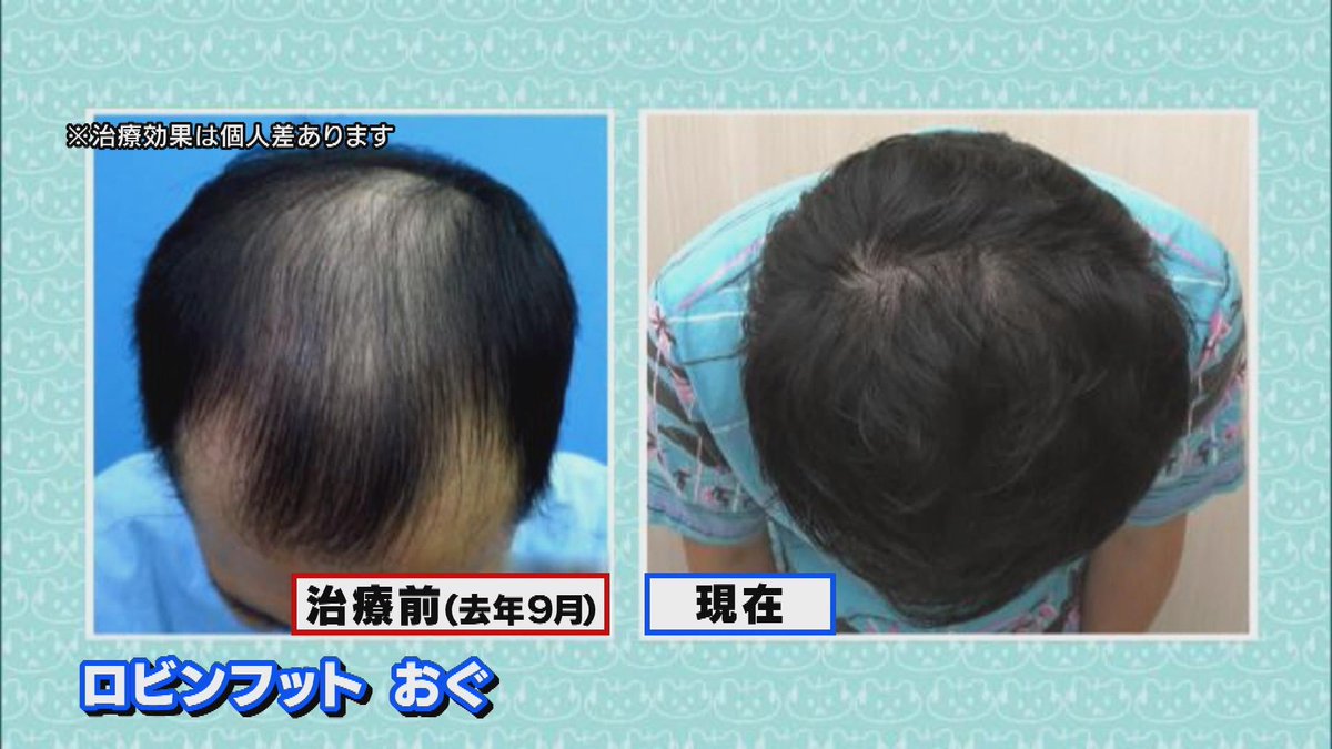 キャン キャン玉城 この画像を紹介するの忘れてました 私もこのお2人みたいになれますように 薄毛芸人発毛プロジェクト Dクリニック Aga 前略大とくさん 中京テレビ