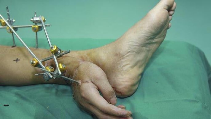 In 2013, doctors working in China successfully grafted a man's hand to his ankle to keep it alive before re-attaching it to his arm.