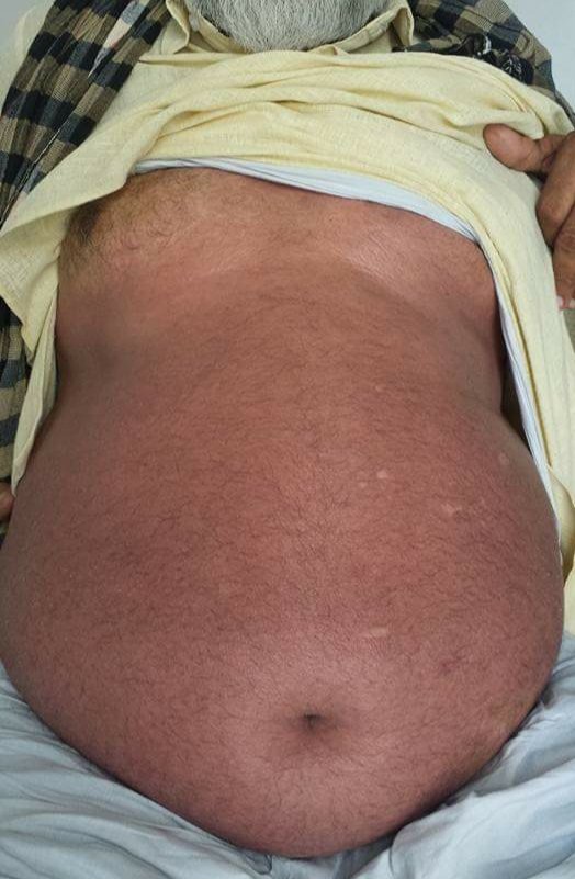 AyurvedaMonk's tweet photo. 1/2
This case is another example of life saving aspect of #Ayurveda
for
@jimmy_wales @Wikipedia &amp; few Allopathy Dr (not all) 
who r trying their best 2 prove #Ayurveda as a pseudoscience.(case detail in 2/2)

#Psoriasis &amp; Various such life threatening diseases,
where allopathy..+ https://t.co/WVvfzTUtQe