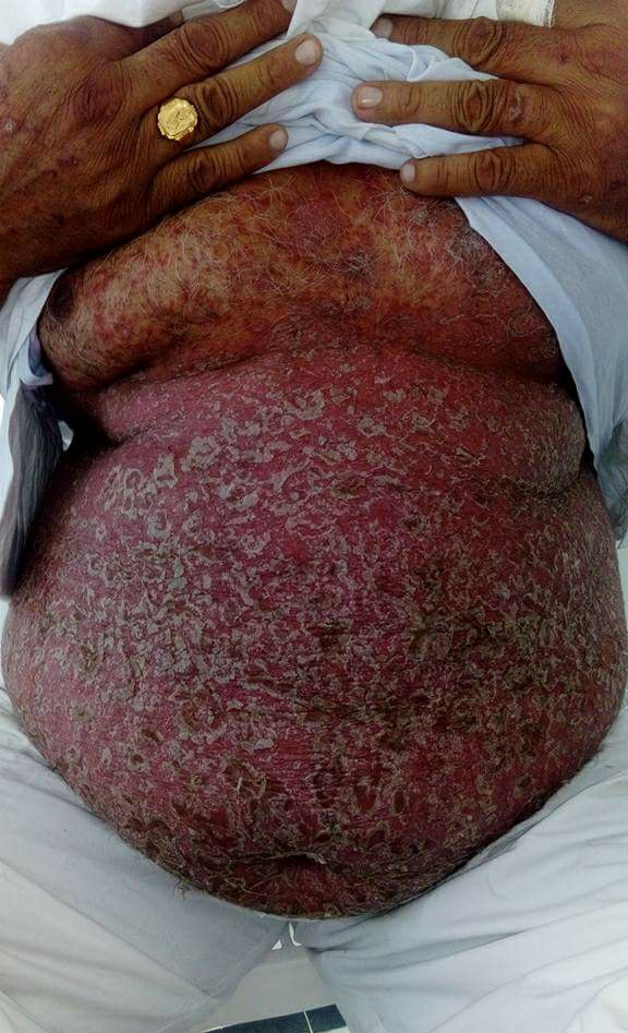 AyurvedaMonk's tweet photo. 1/2
This case is another example of life saving aspect of #Ayurveda
for
@jimmy_wales @Wikipedia &amp; few Allopathy Dr (not all) 
who r trying their best 2 prove #Ayurveda as a pseudoscience.(case detail in 2/2)

#Psoriasis &amp; Various such life threatening diseases,
where allopathy..+ https://t.co/WVvfzTUtQe