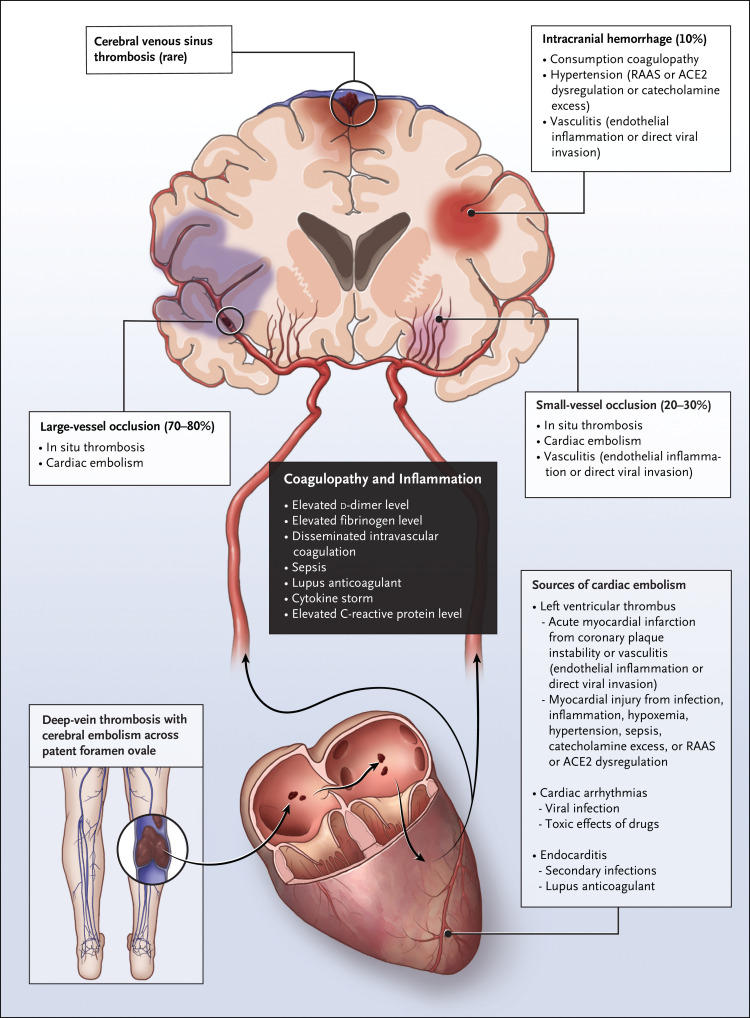 Montecoya's tweet photo. Subtipos de ictus y mecanismo en la infección por SARS-CoV-2 https://t.co/r1G11Rq7JW https://t.co/Dyx5vJJQgV