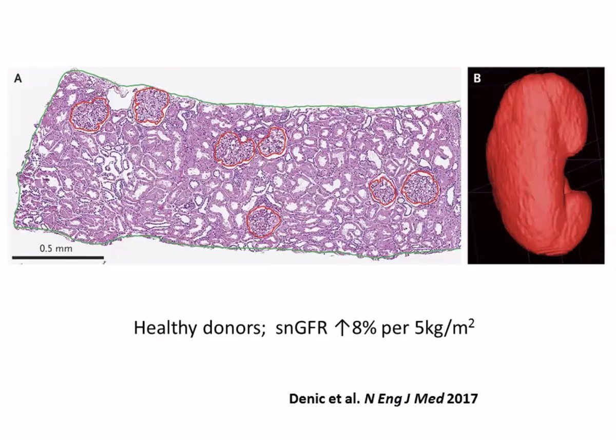 arvindcanchi's tweet photo. Very interesting talk by Dr Tim Ellam on Obesity and kidney disease. How body surface area matters and indexation of this changes the eGFR in obese individuals. #rasprclub https://t.co/rdqJnpDol1