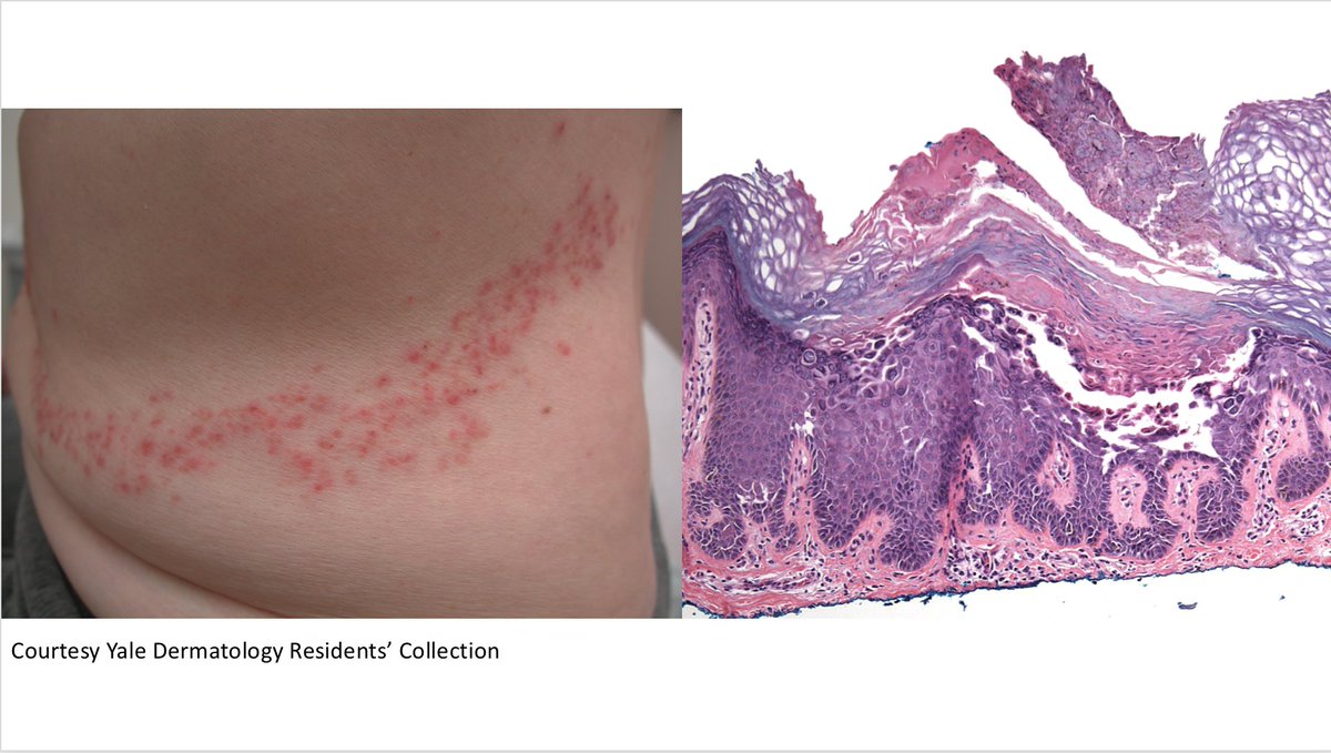 ChristineJKoMD's tweet photo. What's your diagnosis? Short #clinpathcorrelation answer video at https://t.co/O6sNpoEOWN #cpKo #PathTwitter https://t.co/ZnITJUuTVE