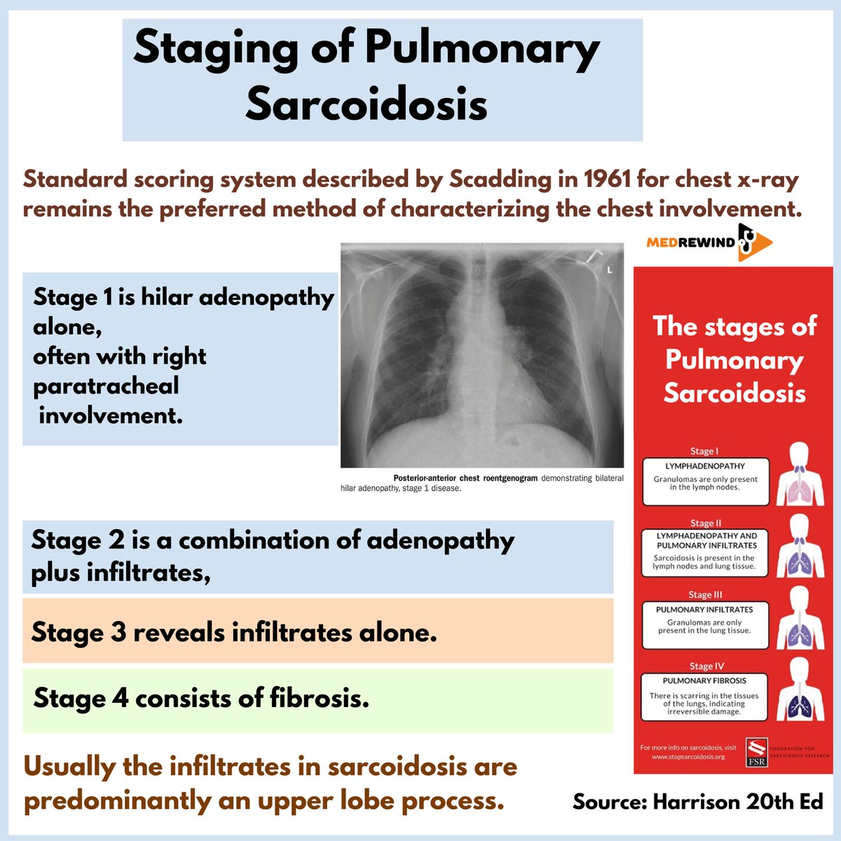MedRewind's tweet photo. Staging of Pulmonary Sarcoidosis https://t.co/gQEBEuXhQ8