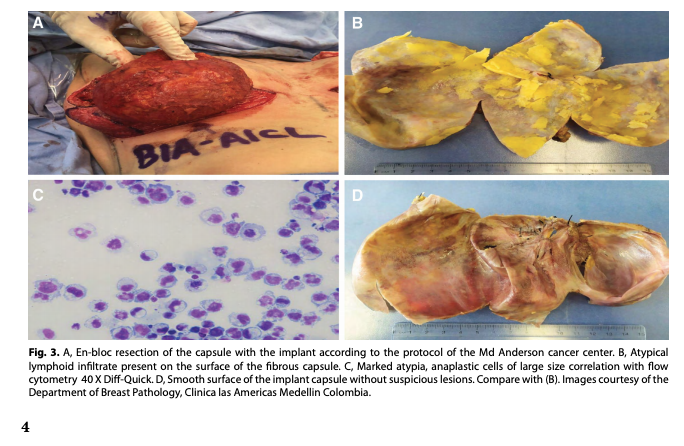 tumastologo1's tweet photo. In the management of patients with Lymphoma associated with breast implants #bialcl,En-bloc resection is the standard of management, guaranteeing complete resection and reducing the risk of relapse https://t.co/gRKaiPSHmU #breast #implants #bcsm #research #latam #implants #latam https://t.co/lY46BjTadO