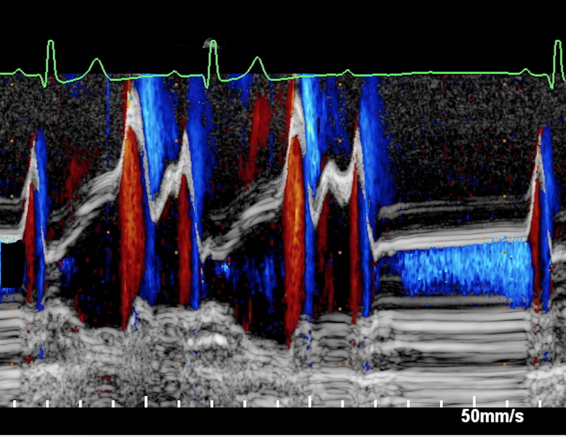 MAecocardio's tweet photo. Que bella es la ECOARRITMOLOGIA¡¡  con técnica M modo color
Insuficiencia mitral diastólica en  paciente con BLOQUEO AV 2 grado tipo I. https://t.co/LfgjzP2TYx