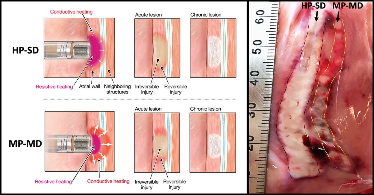JACCJournals's tweet photo. High-power short-duration may ⬆️ PVI durability &amp; ⬇️ ablation time for #AFib. Thicker myocardium requires lower power, longer duration for deeper lesions without overheating.

More on #HPSD &amp; long-term lesion durability from @EladAnter et al: https://t.co/7ETSJ5MH4a #JACCCEP https://t.co/OuI9fCz3Rp