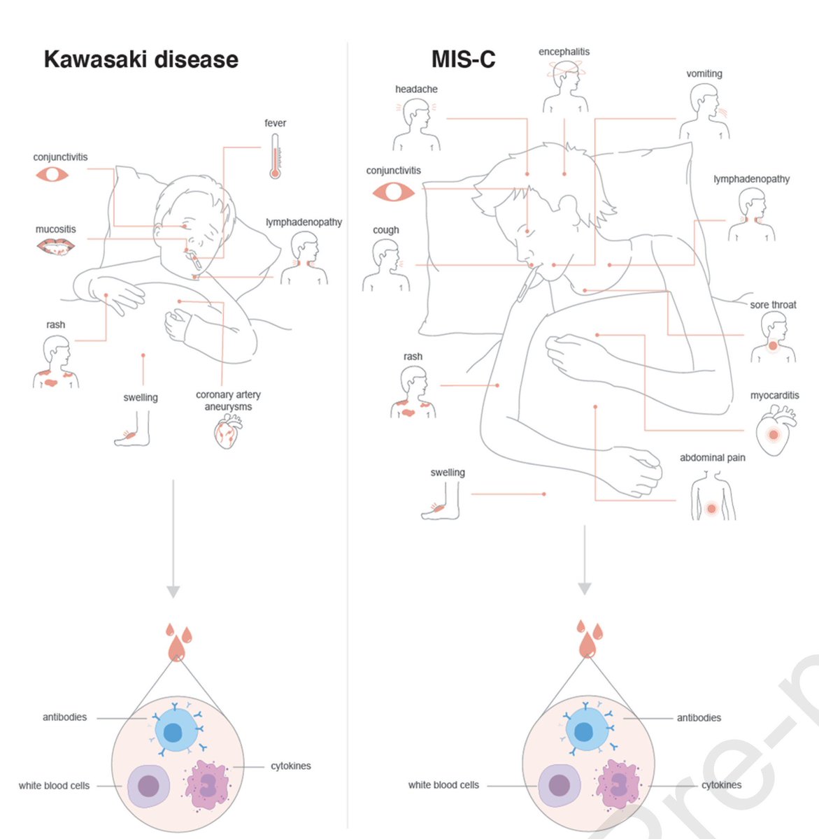 FArtigao's tweet photo. Interesante artículo en @CellCellPress sobre la respuesta inmunológica en el síndrome hiperinflamatorio asociado a #COVID19 (MIS-C) en niños y sus características diferenciales con el #COVID19 grave y la enfermedad de Kawasaki. 
👉 https://t.co/gnp5OaDHvj https://t.co/0xdP4yz7aH