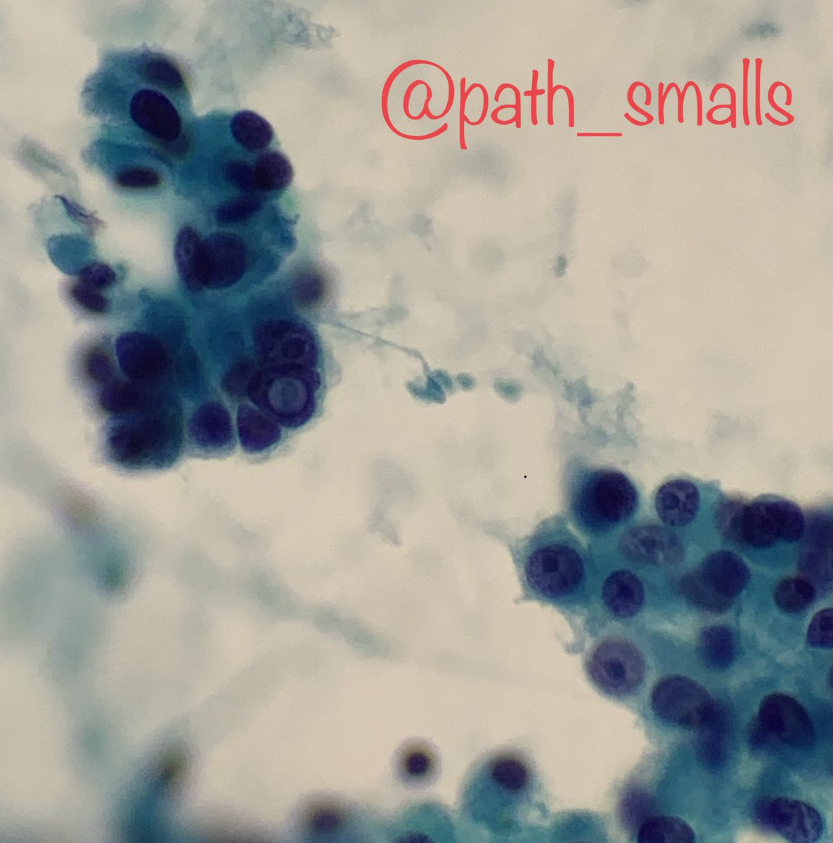 Thyroid FNA - lets go! #cytology #pathboards