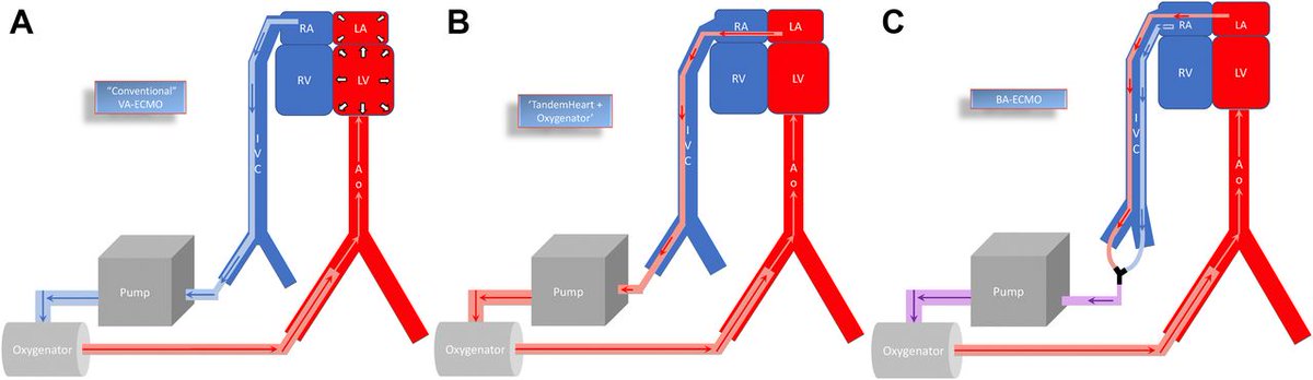 What are the different forms of percutaneous VA-#ECMO and their cannulation? Dr. Isseh and colleagues describe the percutaneous biventricular hemodynamic support using biatrial ECMO. Read in #JACCCaseReports. bit.ly/3551pyt