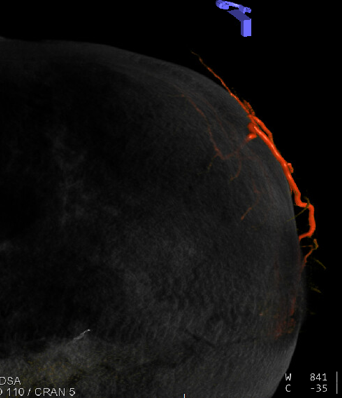 neuroangio1's tweet photo. #subdural #MMAembo time 🍌🧠💀 Check out this juicy 🧃🧃🧃 transosseeous branch to the parietal #dura from the #OccipitalArtery. Could #AnatomicalVariant like this be responsible for some of failed #MMAembo ? Full link here: https://t.co/l5cG4MtDeW @ENossek @eytanraz https://t.co/XLL738BtSS