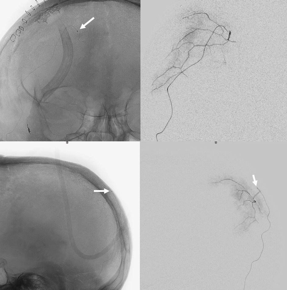 neuroangio1's tweet photo. #subdural #MMAembo time 🍌🧠💀 Check out this juicy 🧃🧃🧃 transosseeous branch to the parietal #dura from the #OccipitalArtery. Could #AnatomicalVariant like this be responsible for some of failed #MMAembo ? Full link here: https://t.co/l5cG4MtDeW @ENossek @eytanraz https://t.co/XLL738BtSS