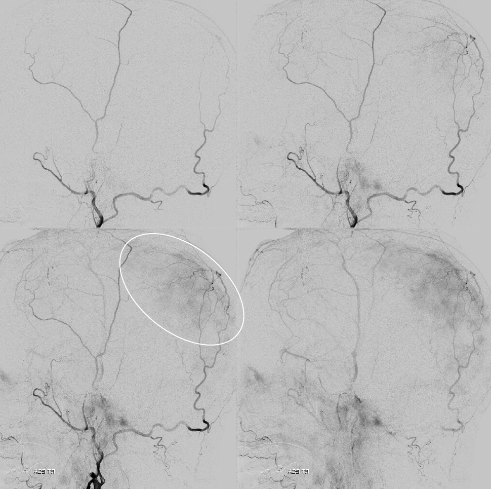 neuroangio1's tweet photo. #subdural #MMAembo time 🍌🧠💀 Check out this juicy 🧃🧃🧃 transosseeous branch to the parietal #dura from the #OccipitalArtery. Could #AnatomicalVariant like this be responsible for some of failed #MMAembo ? Full link here: https://t.co/l5cG4MtDeW @ENossek @eytanraz https://t.co/XLL738BtSS