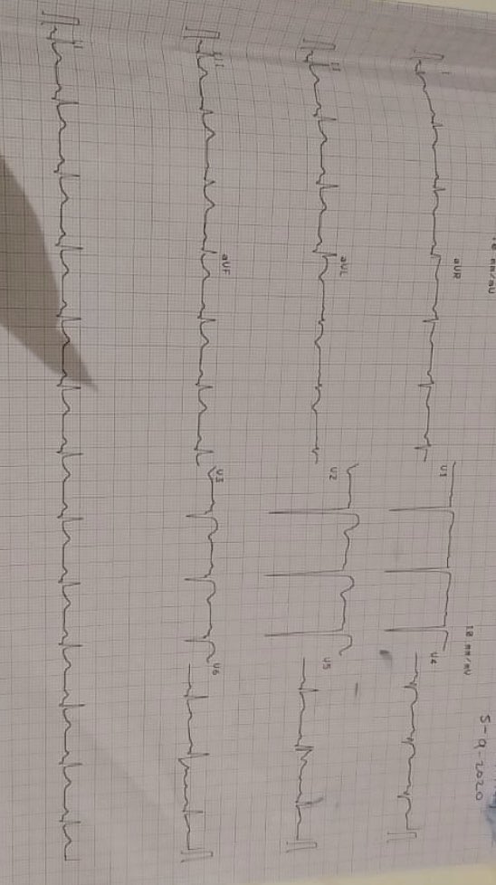 Yet another young patient..44 years..Anterior wall MI..Going home today after a successful angioplasty. Alarmingly high incidence of major heart issues in the young population with no apparent risk factor. Some common observations in most of them..