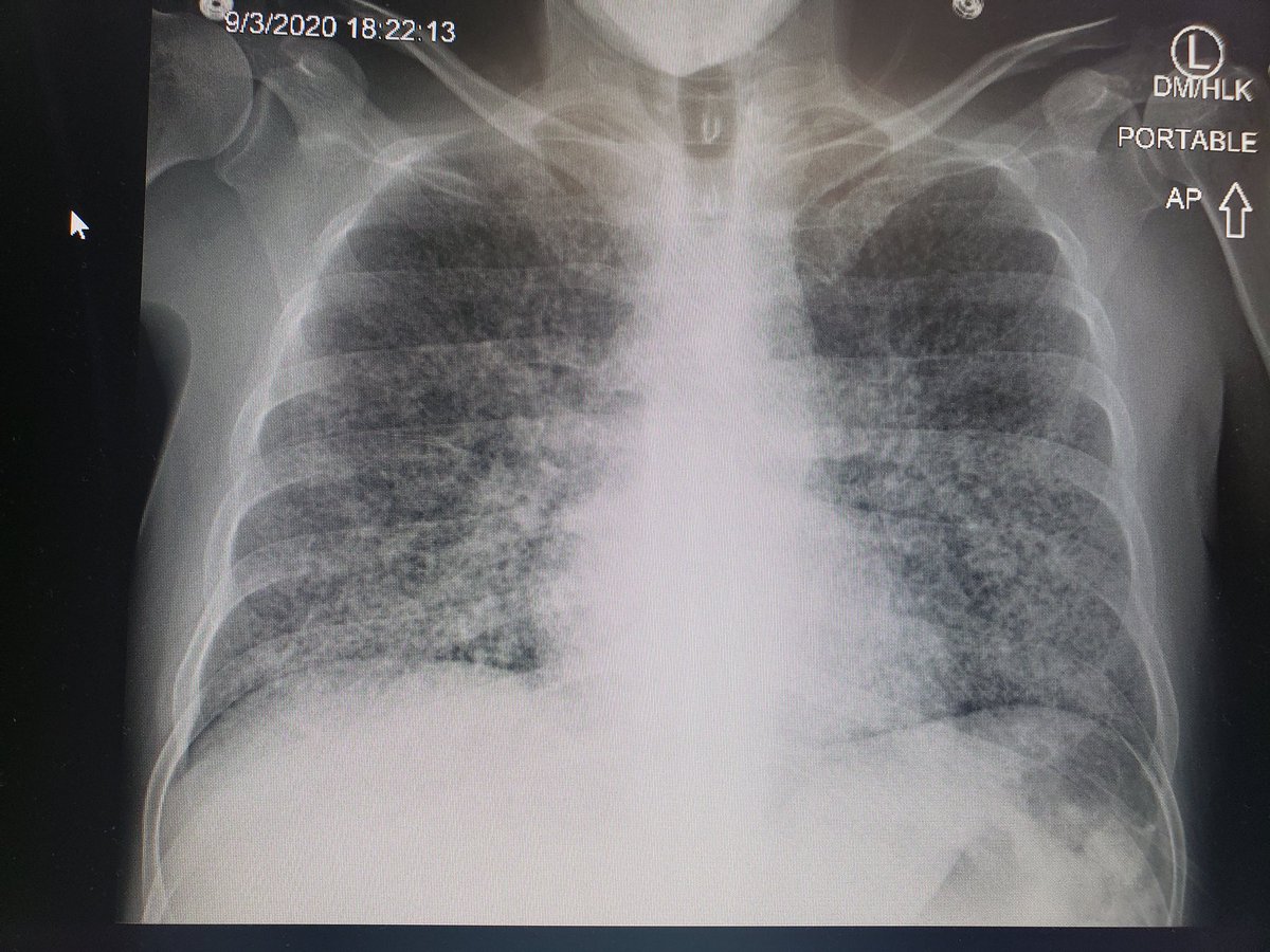 AnnaCondaMD's tweet photo. On today's version of "Not all that coughs is Covid" ... wow. https://t.co/9qd5fiLb7x