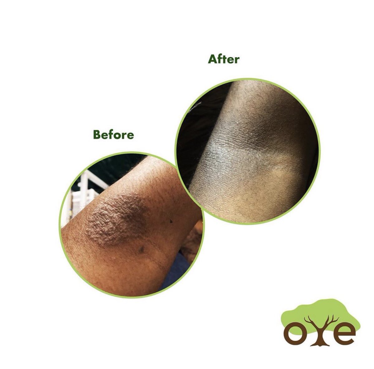 oyegreen's tweet photo. Our shea butter is whipped with coconut, almond, lavender, jojoba and tea tree oil which help to reduce the presence of stretch marks and scars. It is also great for hair growth, retention and moisture.

Get 50% off your next purchase if you send us pictures of your results!💚 https://t.co/vA28Pm64Ac