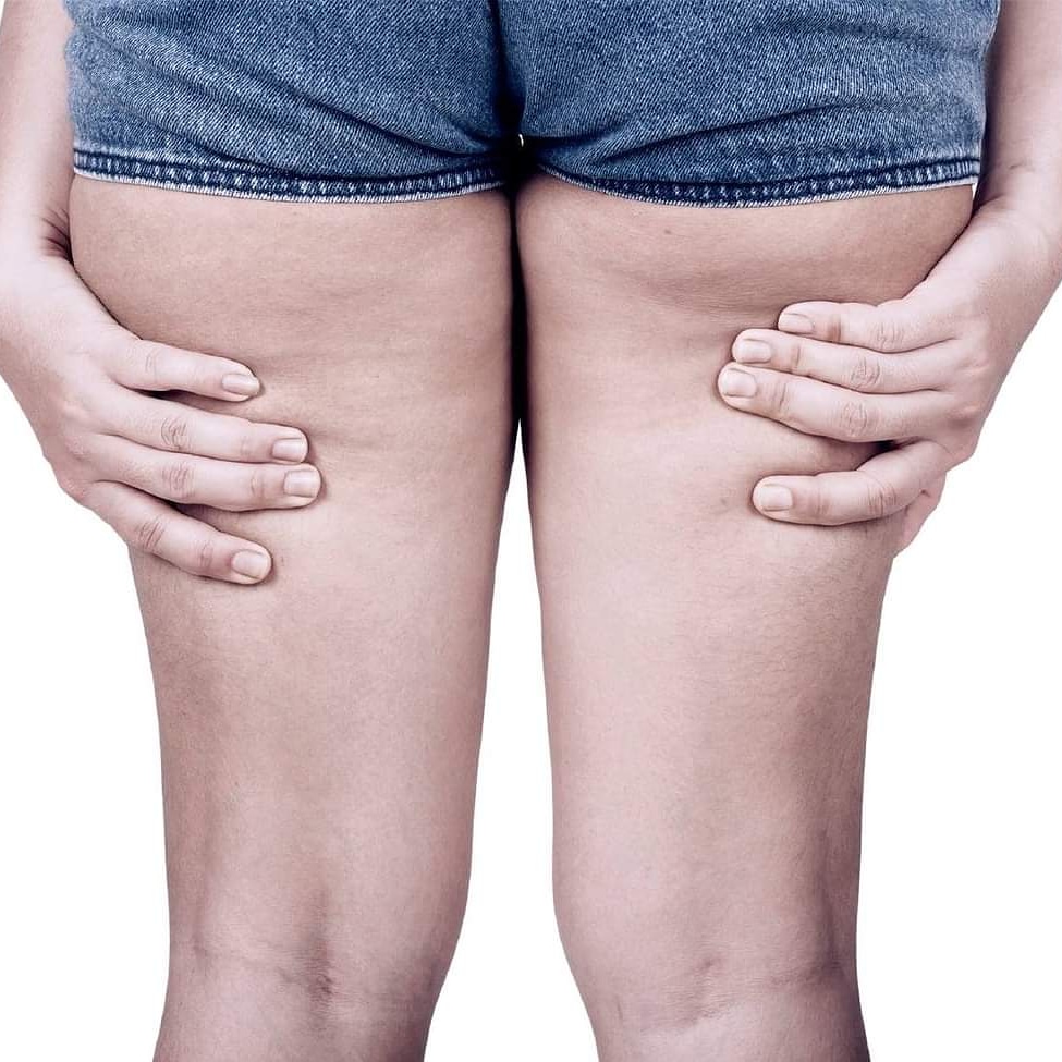 гиперпигментация варикоз. целлюлит на ногах причины. классификация целлюлита. целлюлит на ногах причины. ноги в растяжках и целлюлите.