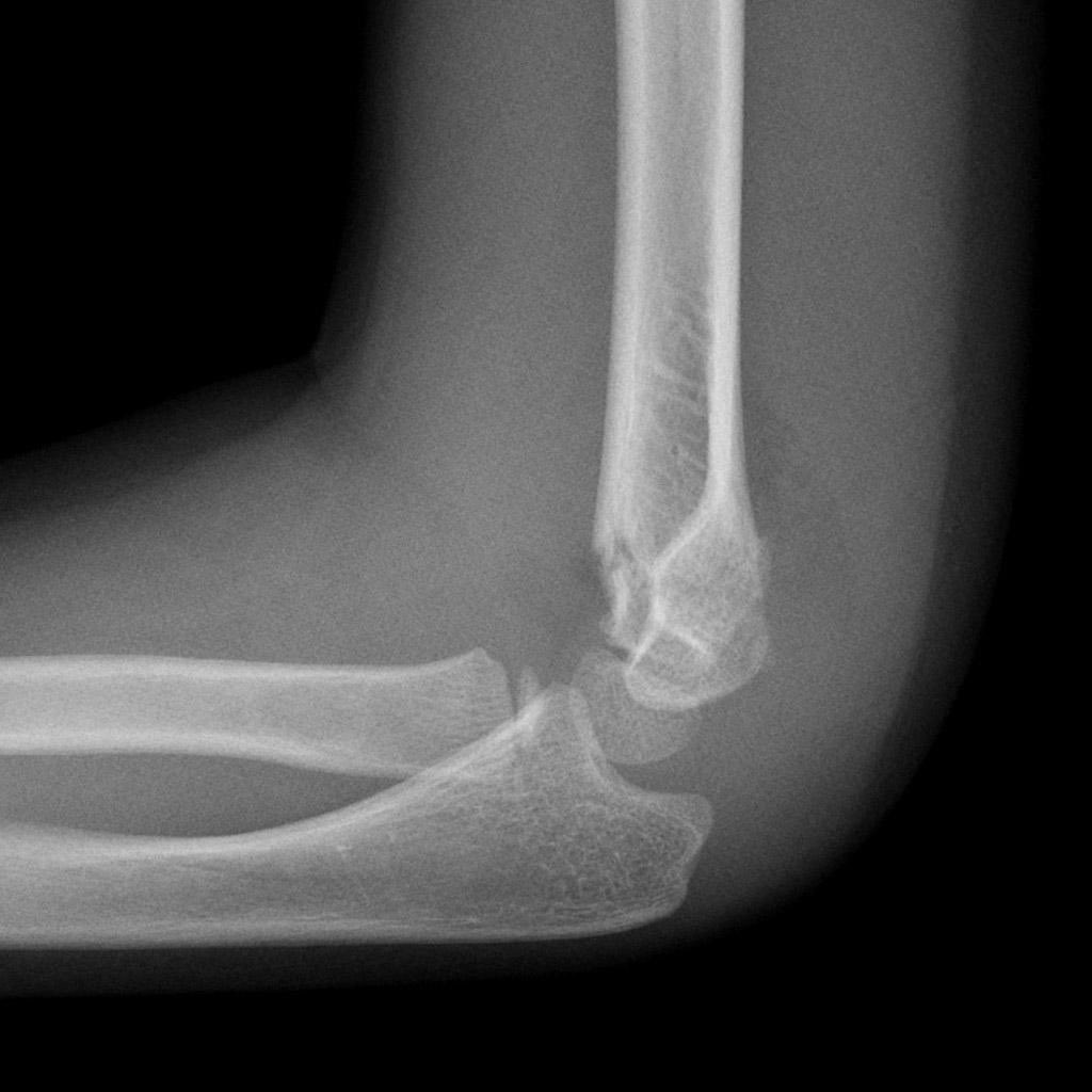 fundamentalofSM's tweet photo. What kind of fracture is this? A. Radial head fracture B. Olecranon fracture C. Supracondylar fracture D. Coronoid process fracture. comment down below. Answer will be posted tomorrow. 
Image taken from https://t.co/pu93FztjhZ https://t.co/yqdO23CgKq