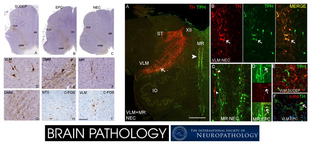 Medullary tyrosine hydroxylase catecholaminergic neuronal populations in sudden unexpected death in epilepsy, <a href="/UCLIoN/">UCL Queen Square Institute of Neurology</a>, <a href="/UoS_Medicine/">Southampton Medicine</a>, <a href="/UniMelbMDHS/">UniMelb MDHS</a> et al, in <a href="/brainpathol/">Brain Pathology</a> (<a href="/IntSocNeuropath/">International Society of Neuropathology</a>)

onlinelibrary.wiley.com/doi/10.1111/bp…

#brainstem #medulla #preBötC #neuropathology #neurobiology #SUDEP
