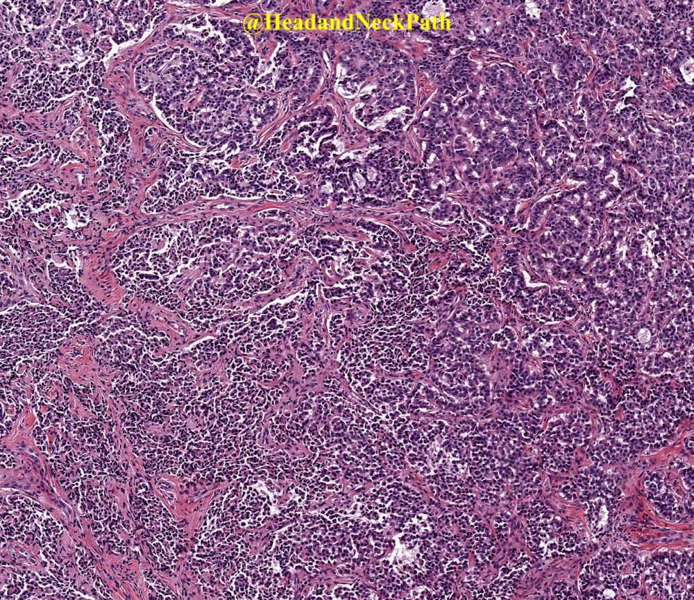 Based on new WHO neuroendocrine tumor criteria, middle ear adenoma gets a new NAME: MeMeNET--Middle Ear Mixed Epithelial Neuroendocrine Tumor. Look for it next year in the new WHO Blue Book Series... #ENTPath #Pathology #HeadandNeckPath #PathologyTweet
